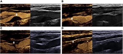 Assessment of Carotid Plaque Stability Using Contrast-Enhanced Ultrasound and Its Correlation With the Expression of CD147 and MMP-9 in the Plaque